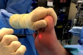 Surgical method removes warts