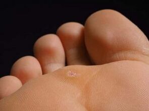 The cause of the plantar warts