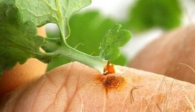 How to get a wart with a celandine