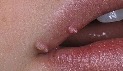 The type of papilloma in humans