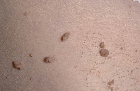 Papilloma