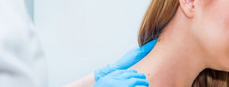 Papilloma on the neck