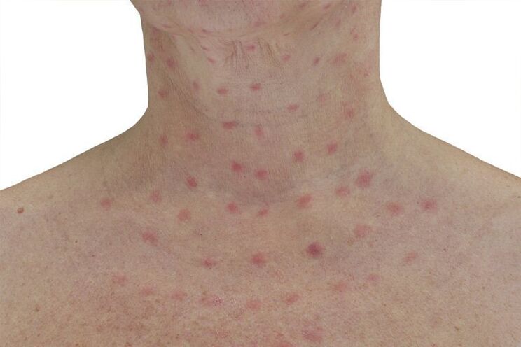 Skin after electrokoagulation
