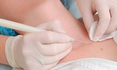 The method of removal of papillomas in the neck