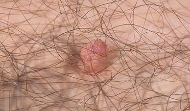 How to move a human papilloma virus