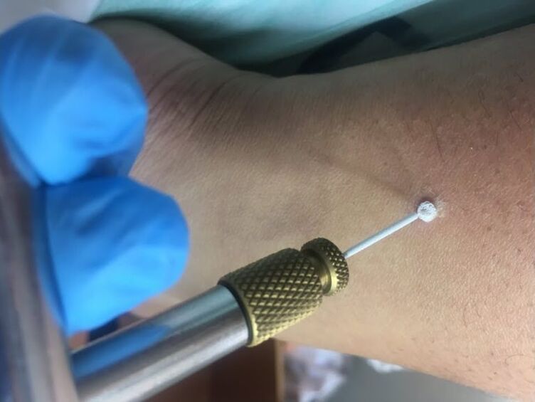 how to get rid of warts