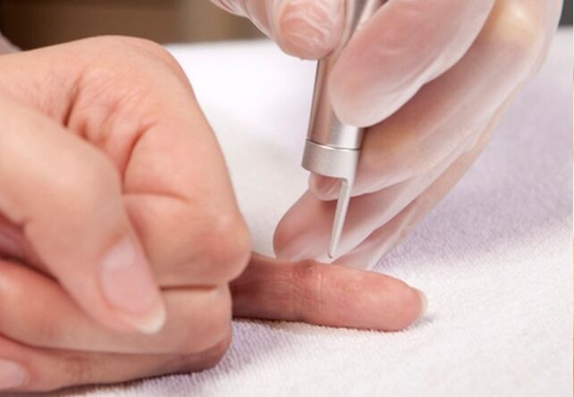 remove warts on the fingers