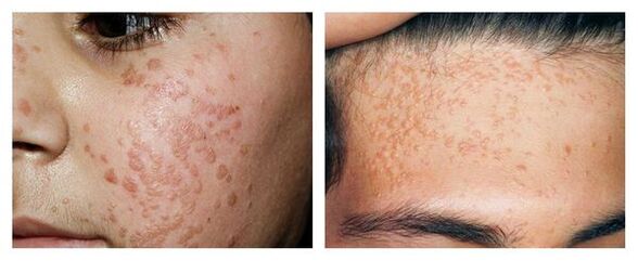 A flat wart in the face