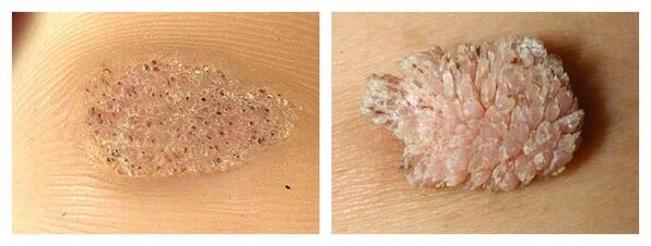 Mosaic warts and seller warts