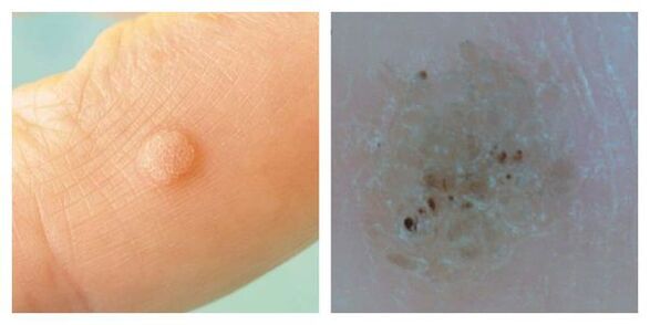 Normal warts during examination and dermatoscopy