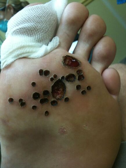 Skin after removal of laser warts in the foot