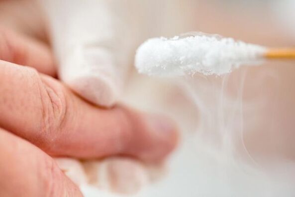 Wart treatment with liquid nitrogen
