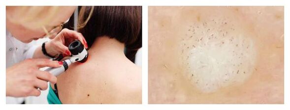 Warts dermatoscopy