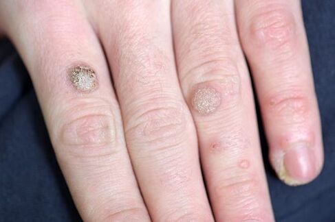 Warts in the arms