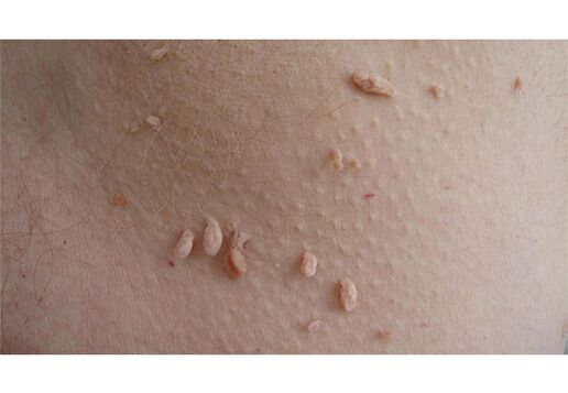 A sign of HPV infection is the appearance of papillomas on the body