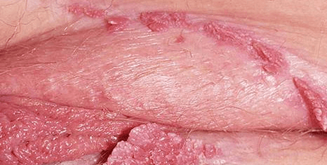 Candyloma