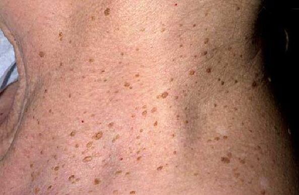Senil warts