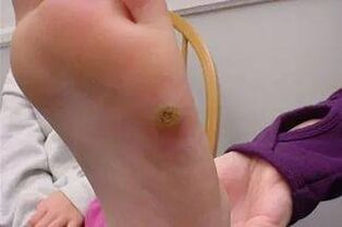 Warts in hand