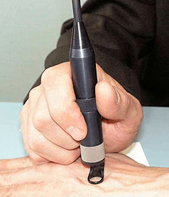 Papilloma treatment