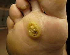 Papillomas Subanary